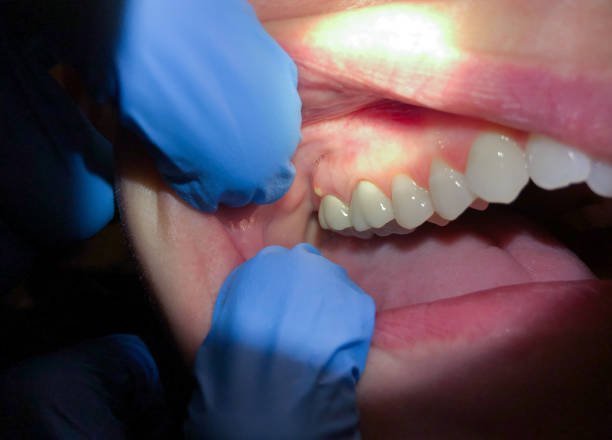 Best Emergency Root Canal Therapy in Storrs, CT